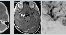 Đặt stent cứu trẻ 11 tuổi bị phồng mạch máu não
