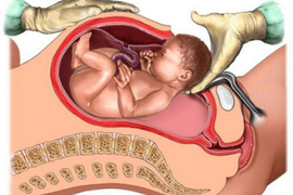 Có nên chủ động sinh mổ sớm?