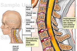 Gãy cột sống để lại nhiều biến chứng nguy hiểm