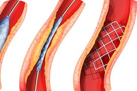 Bệnh động mạch ngoại biên có nguy hiểm?