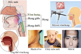 Thực phẩm có thể gây ung thư vòm họng "nhanh khủng khiếp"