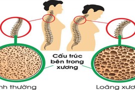 Những thói quen khi trẻ khiến chưa già đã loãng xương