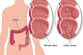 28 tuổi ung thư đại trực tràng vì thói quen nhiều người mắc
