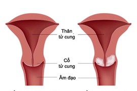 Những điều cần biết về ung thư cổ tử cung