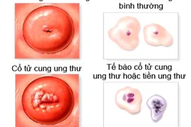 Cách dễ dàng phát hiện ung thư cổ tử cung