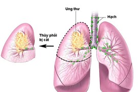 Giúp người ung thư phổi tự tin với chuyện vợ chồng