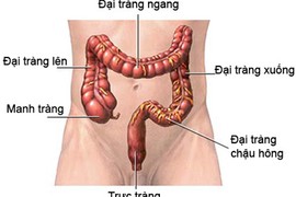 Dấu hiệu giúp phát hiện ung thư đại tràng