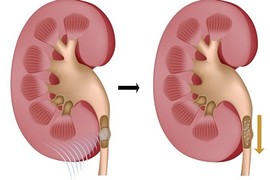 Chi tiết quy trình tán sỏi thận