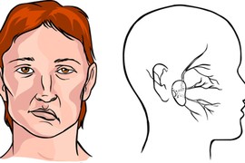 Cách xử lý khi bị cấm khẩu, méo miệng do trúng gió