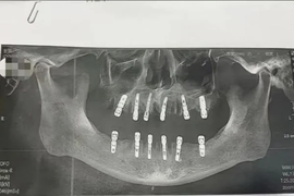 Tử vong sau khi nhổ 23 chiếc răng trong một ngày