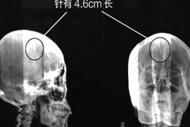 Kỳ lạ kim khâu nằm trong đầu mà không hay biết