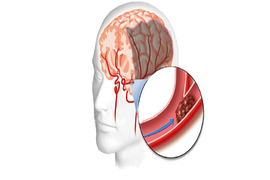 Các yếu tố nguy cơ dẫn đến thiếu máu não 