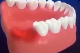 Trải nghiệm thực tế quá trình nhổ răng khôn trong chỉ với 7 phút tại Shinbi Dental