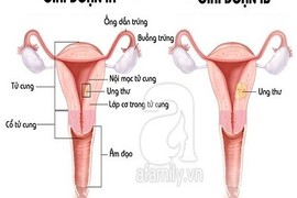 Ung thư buồng trứng: điều trị hiệu quả hơn khi dùng thuốc 