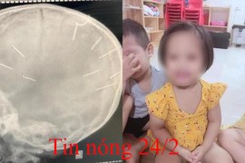 Tin nóng 24/2: Sức khỏe bé gái bị găm 9 đinh vào đầu giờ ra sao?