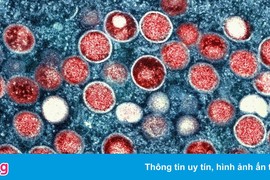 Người nhiễm virus Mpox gây bệnh đậu mùa khỉ nên đi xét nghiệm HIV