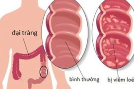 Bài thuốc chữa dứt viêm đại tràng từ rau trong vườn 