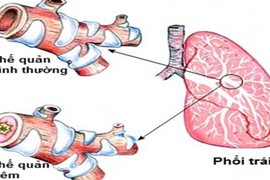 Mẹo phân biệt hen phế quản và tắc nghẽn phổi mãn tính 