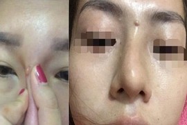 Nhận trái đắng từ trào lưu nâng mũi bằng tiêm filler