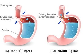 Cách tránh trào ngược dạ dày, thực quản trong và sau Tết