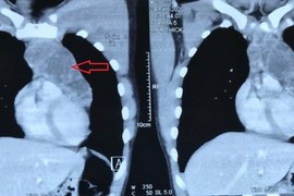 Ho nhói nhẹ, vào viện phát hiện khối u ngực chèn ép nguy hiểm