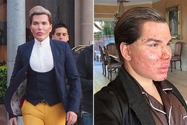 Rodrigo Alves phá nát mặt vì muốn làm búp bê sống Ken