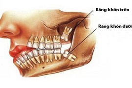 Nhổ răng khôn có thể gặp những nguy hiểm gì?