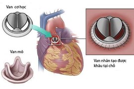 Dùng tiêu sợi huyết cứu bệnh nhân kẹt van tim nhân tạo