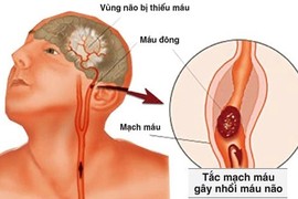 Biện pháp phòng ngừa bệnh thiểu năng tuần hoàn não gây tai biến