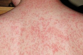 Ca mắc rubella vừa phát hiện ở Hà Nội đã tiêm vaccine 