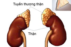 Lạm dụng thuốc giảm đau, bệnh nhân suy tuyến thượng thận