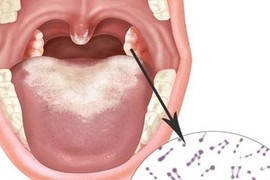 Triệu chứng của bệnh bạch hầu và cách chăm sóc người bệnh