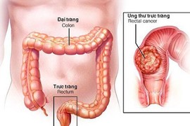 Đi ngoài liên tục, sút cân… đi khám phát hiện ung thư trực tràng