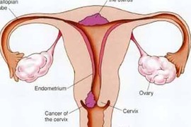 Triệu chứng của UTCTC ở giai đoạn sớm là gì?