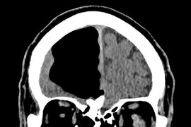 Nhập viện vì đau đầu, choáng váng thấy điều này trong não