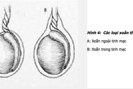 Đột ngột đau dữ dội 'hạt cà', thiếu niên 14 tuổi mất cơ hội làm cha