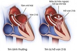 Bệnh hở van tim của Tuấn Hưng nguy hiểm ra sao?