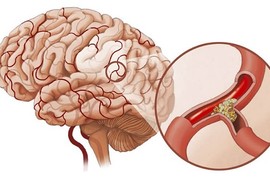 Phi công huyền thoại Nguyễn Văn Bảy qua đời vì xuất huyết não: Cách phòng ngừa bệnh?