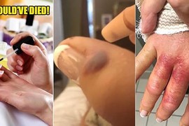 Suýt mất mạng vì nhiễm virus ăn thịt khi đi làm móng tay 