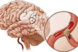 3 triệu chứng khó chịu khi ngủ cảnh báo bệnh nhồi máu não