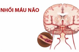 Hai vợ chồng cùng bị nhồi máu não, tất cả do thói quen này