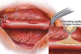 Phát minh keo hàn gắn trái tim độc đáo