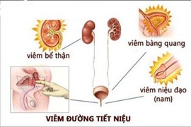 Nồm ẩm làm tăng nguy cơ viêm đường tiết niệu ở phụ nữ