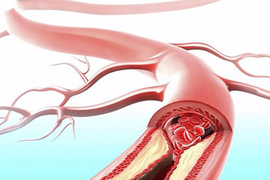 Công thức "vàng" làm sạch mạch máu hiệu quả
