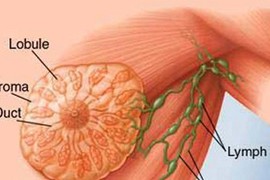 Hiểu lầm ngớ ngẩn về nguyên nhân ung thư vú