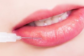 Sự thật tiêm filler môi làm đẹp ít ai biết 