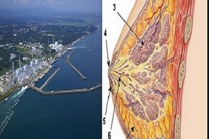 Phóng xạ tại Nhật tăng khả năng gây ung thư vú