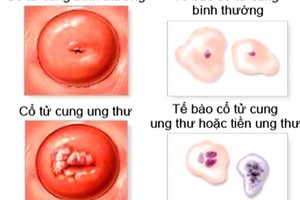 9 sự thật giật mình về ung thư cổ tử cung