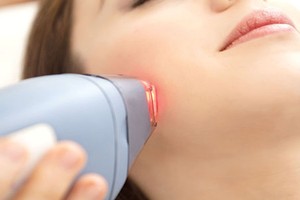 Triệt lông bằng laser tăng nguy cơ ung thư?