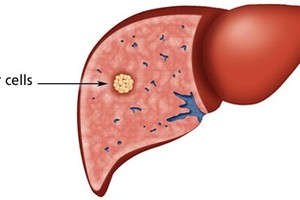 Gan nhiễm mỡ có nguy hiểm không?